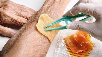 Wound dressing, Doctor cleaning and wash infected wound in chronic senior diabetes patient with normal saline and povidone iodine, Accidental wound care treatment in elder old man.